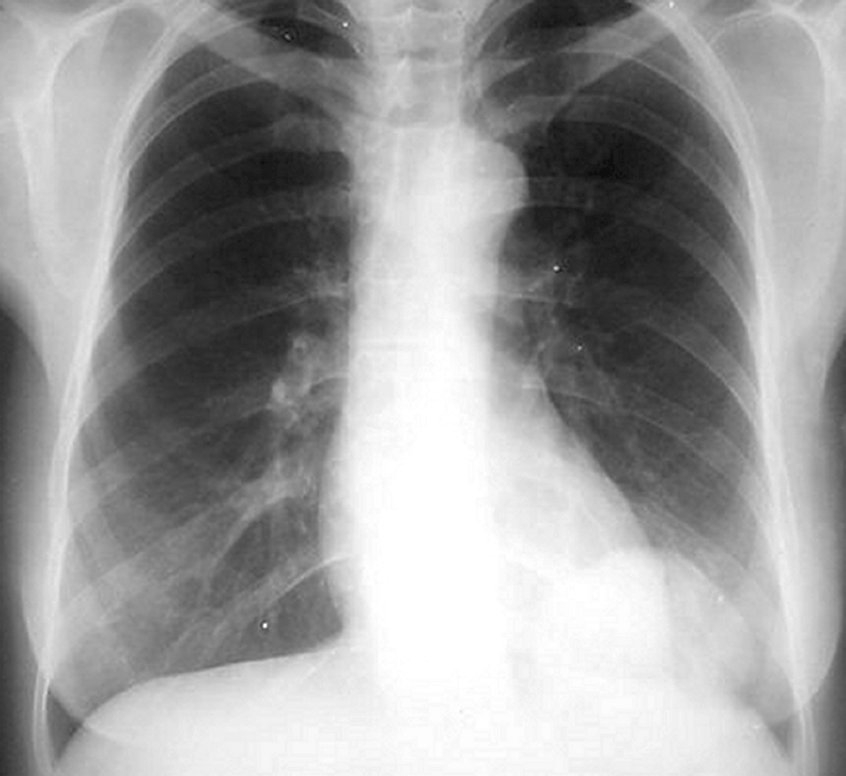 Chist hidatic hepatic